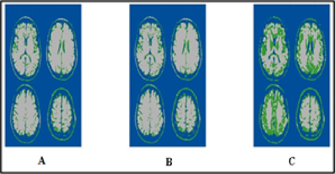 Brain MRI image classification using (A) the SMM method, (B) the AWT method, and (C) the SA-NLM method.